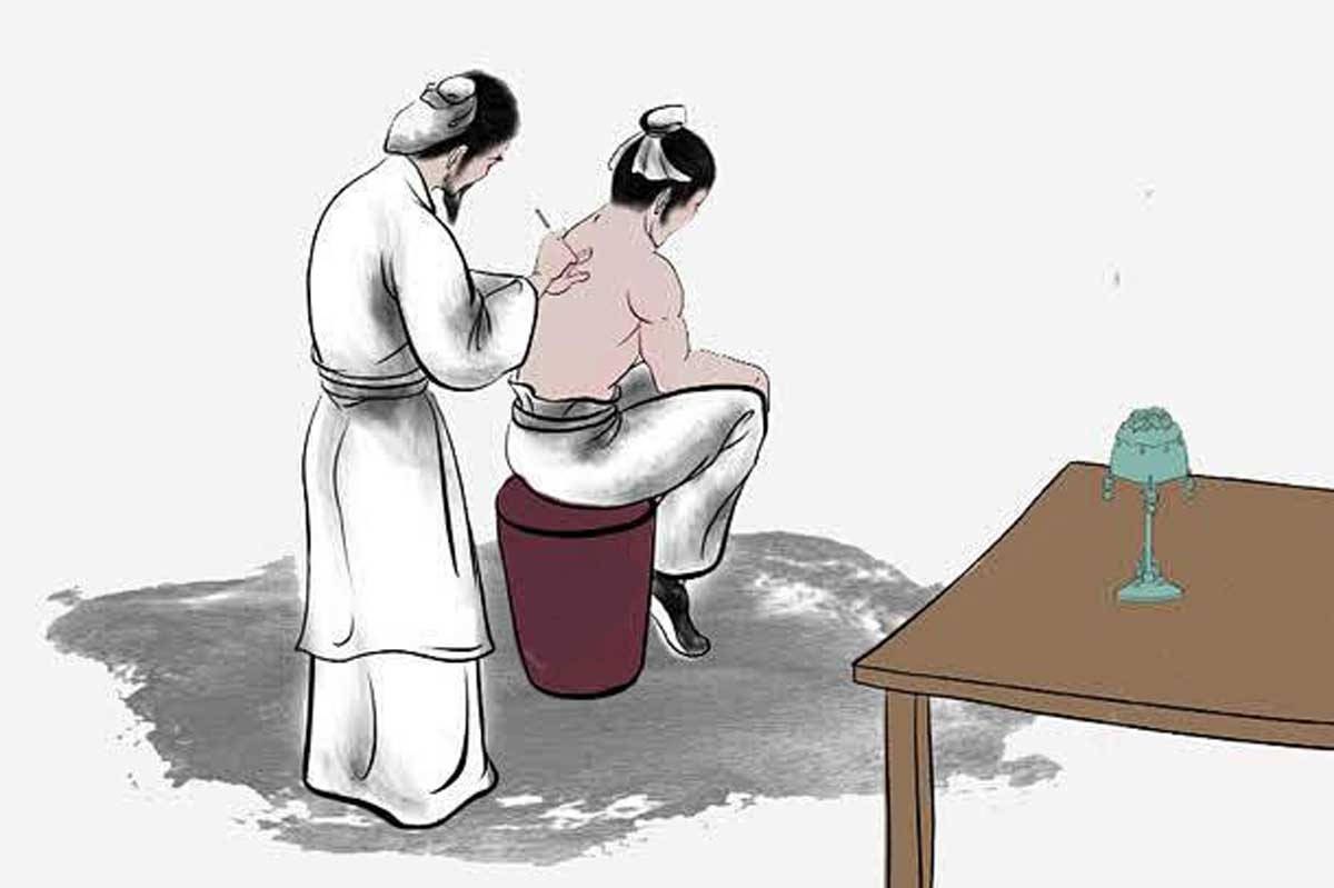 针灸 针灸