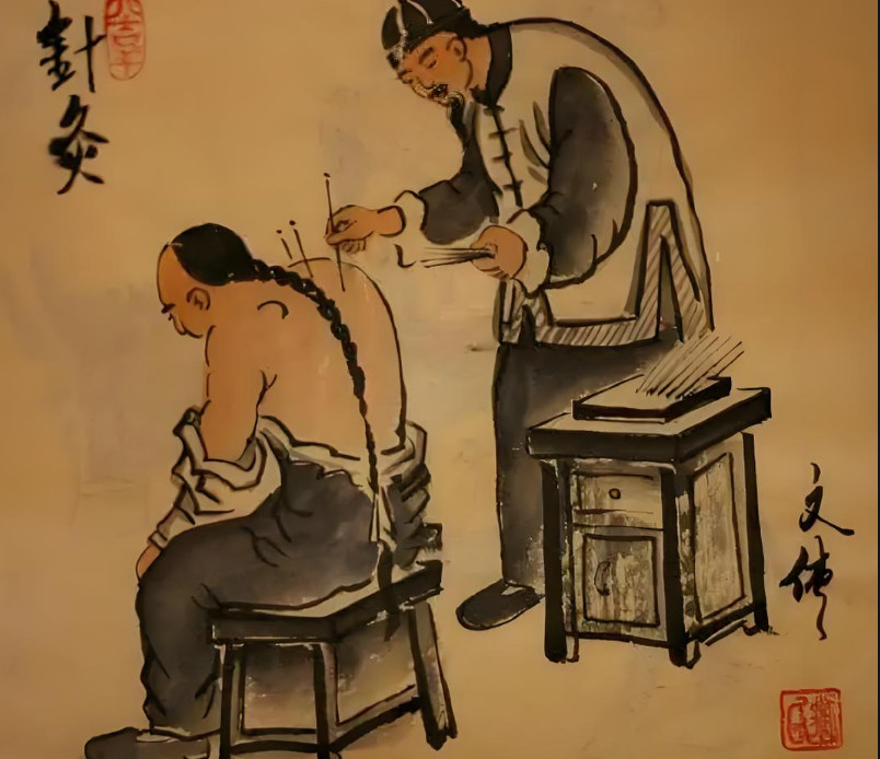 针灸 针灸
