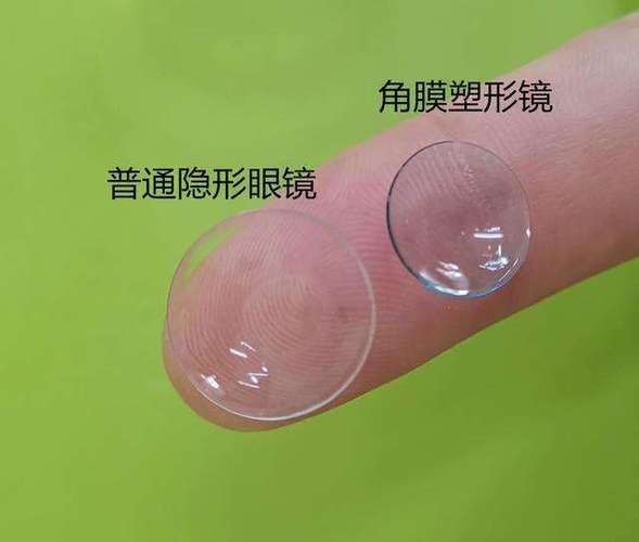 角膜塑形镜配镜